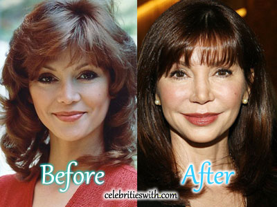 Victoria Principal Plastic Surgery