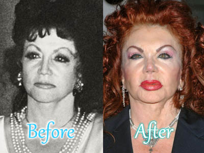 Jackie Stallone Plastic Surgery