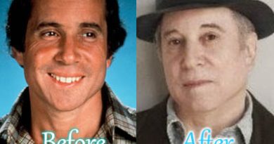 Paul Simon Plastic Surgery