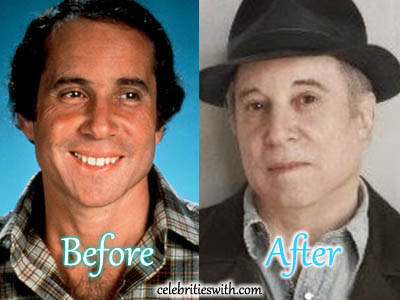 Paul Simon Plastic Surgery