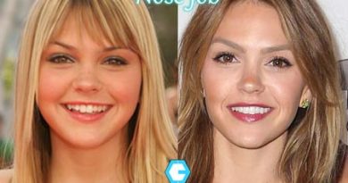 Aimee Teegarden Nose Job