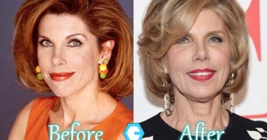 Christine Baranski Plastc Surgery Facelift