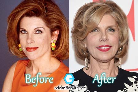 Christine Baranski Plastc Surgery Facelift