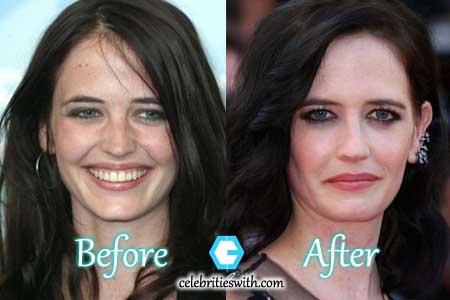 Eva Green Plastic Surgery