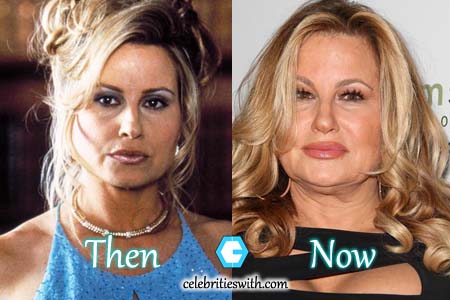 Jennifer Coolidge Facelift, Fillers Photo