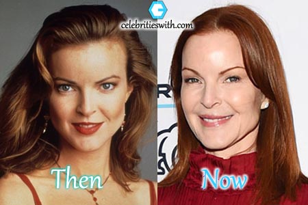 Marcia Cross Plastic Surgery, Botox Marcia Cross Botox