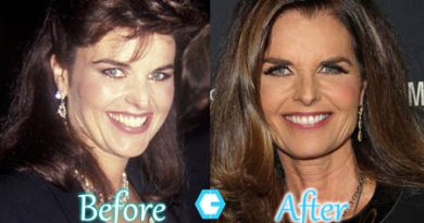 Maria Shriver Plastic Surgery