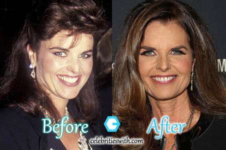 Maria Shriver Plastic Surgery