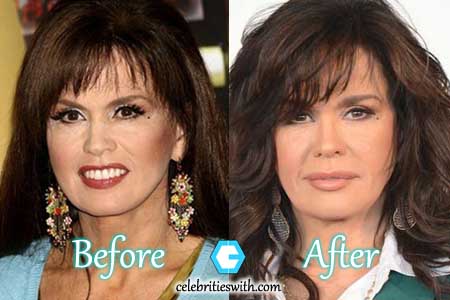 Marie Osmond Plastic Surgery