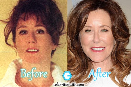 Mary McDonnell Plastic Surgery