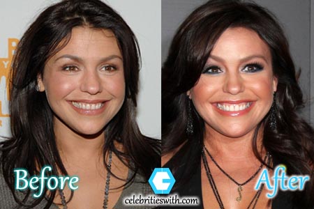 Rachael Ray Plastic Surgery