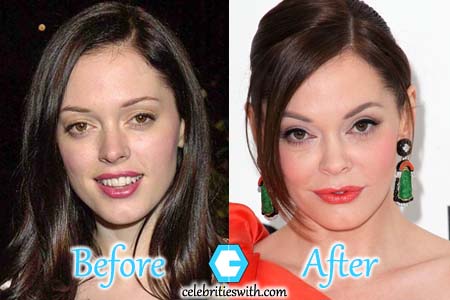 Rose McGowan Plastic Surgery