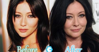 Shannen Doherty Plastic Surgery Picture