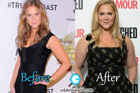 Amy Schumer Weight Gain, Plastic Surgery, Before and After ...