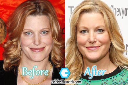 Anna Gunn Nose Job. 