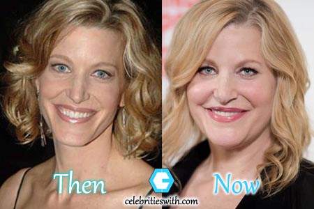 Anna Gunn Plastic Surgery. 