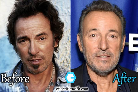 Bruce Springstee Facelift Picture Bruce Springsteen Plastic Surgery