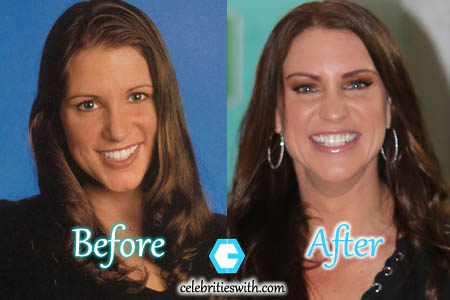 stephanie mcmahon surgery plastic after before boob job celebritieswith