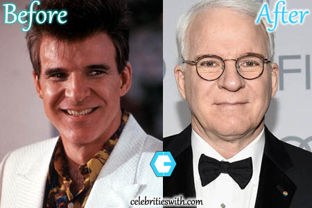 Steve Martin Plastic Surgery Picture Steve Martin Plastic Surgery