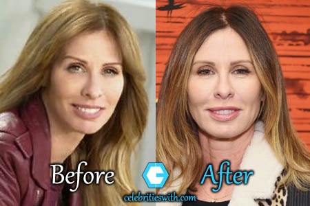 Carole Radziwill Plastic Surgery Carole Radziwill Plastic Surgery