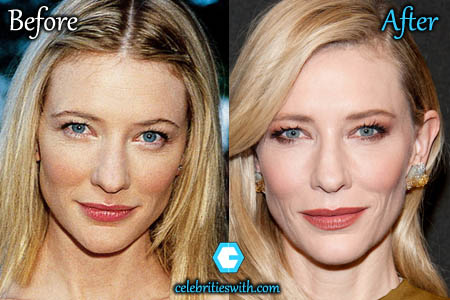 Cate Blanchett Plastic Surgery Cate Blanchett Plastic Surgery