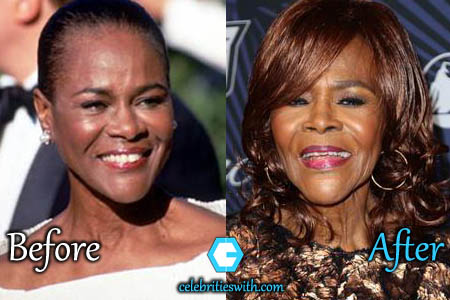 Cicely Tyson Plastic Surgery Cicely Tyson Plastic Surgery