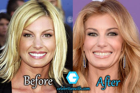 Faith Hill Plastic Surgery Faith Hill Plastic Surgery