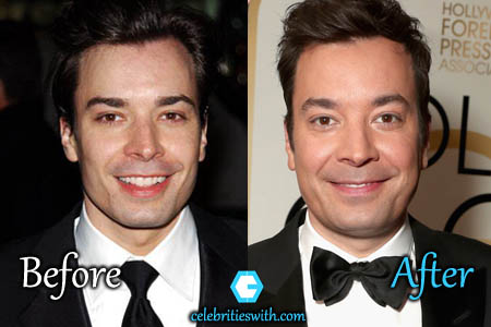 Jimmy Fallon Plastic Surgery Jimmy Fallon Plastic Surgery