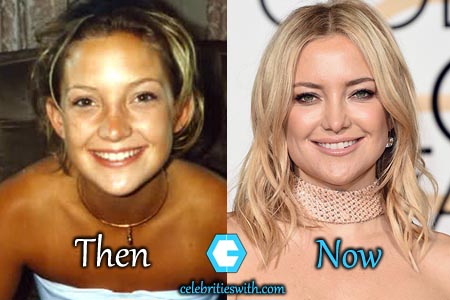 Kate Hudson Plastic Surgery Kate Hudson Plastic Surgery