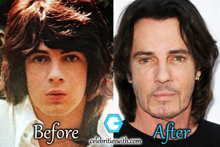 Rick Springfield Plastic Surgery Rick Springfield Plastic Surgery