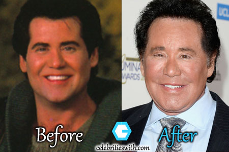 Wayne Newton Plastic Surgery: Facelift, Eyelift, Before After Pictures