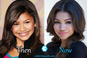 Zendaya Plastic Surgery, Nose Job, Chin Surgery, Before After Pics ...