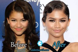 Zendaya Plastic Surgery, Nose Job, Chin Surgery, Before After Pics