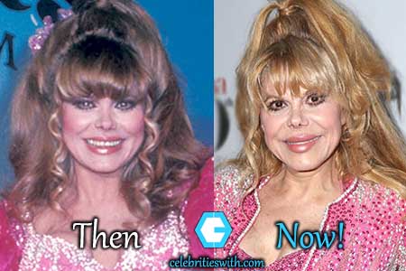 Charo Plastic Surgery Before After