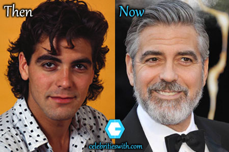 George Clooney Plastic Surgery, Eyelid Surgery, Nose Job, Before After ...