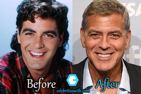 George Clooney Plastic Surgery