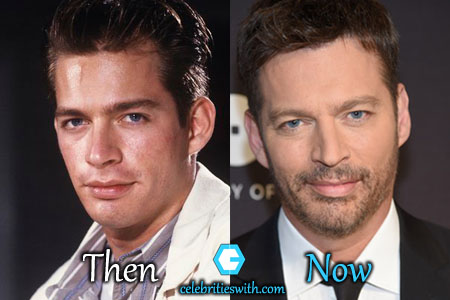 Harry Connick Jr Jaw Harry Connick Jr Jaw