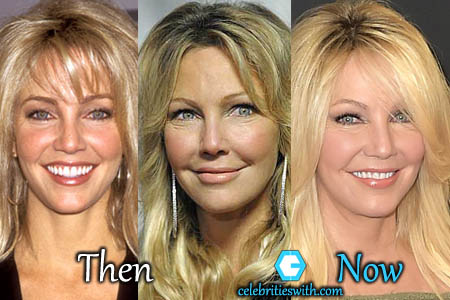 Heather Locklear Plastic Surgery Heather Locklear Plastic Surgery