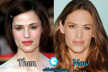Jennifer Garner Lips Injection Jennifer Garner Lips Injection