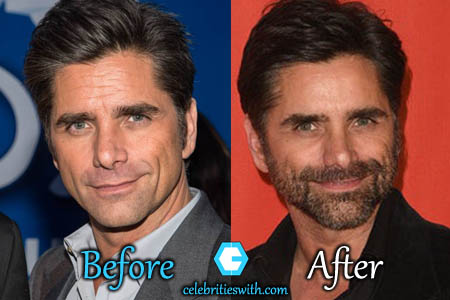 John Stamos Plastic Surgery John Stamos Plastic Surgery