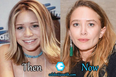 Mary Kate Olsen Nose Job.