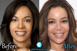 hostin botox