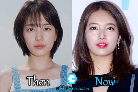 Asian nose job before after