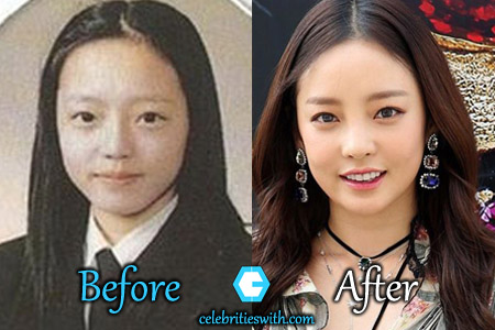 Goo Hara Plastic Surgery Goo Hara Plastic Surgery
