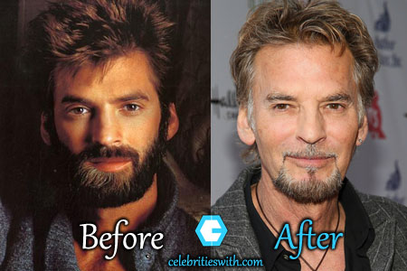 Kenny Loggins Plastic Surgery Kenny Loggins Plastic Surgery