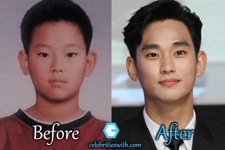 Kim Soo Hyun Plastic Surgery Kim Soo Hyun Plastic Surgery