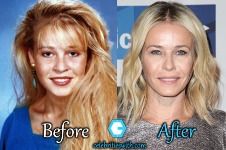 Chelsea Handler Plastic Surgery - The Girl Is In News For 
