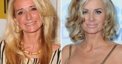 Kim Richards before and after cosmetic surgery