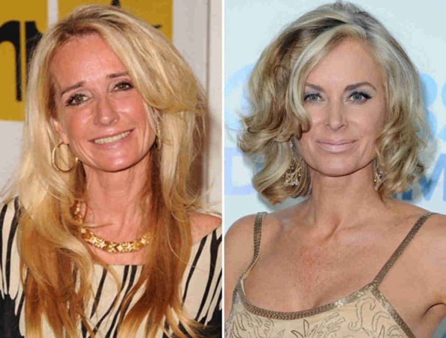 Kim Richards before and after cosmetic surgery