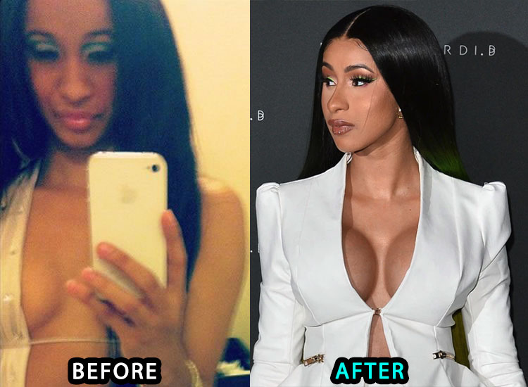 Cardi B Boob Job Picture Before and After